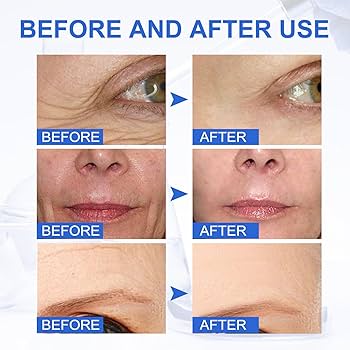 🎁🎁 2 x 1 ENVÍO GRATIS - BOTOX FACIAL PARA ARRUGAS - Bot Solution™