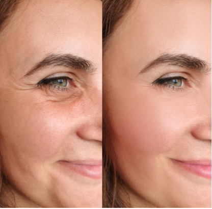 🎁🎁 2 x 1 ENVÍO GRATIS - BOTOX FACIAL PARA ARRUGAS - Bot Solution™